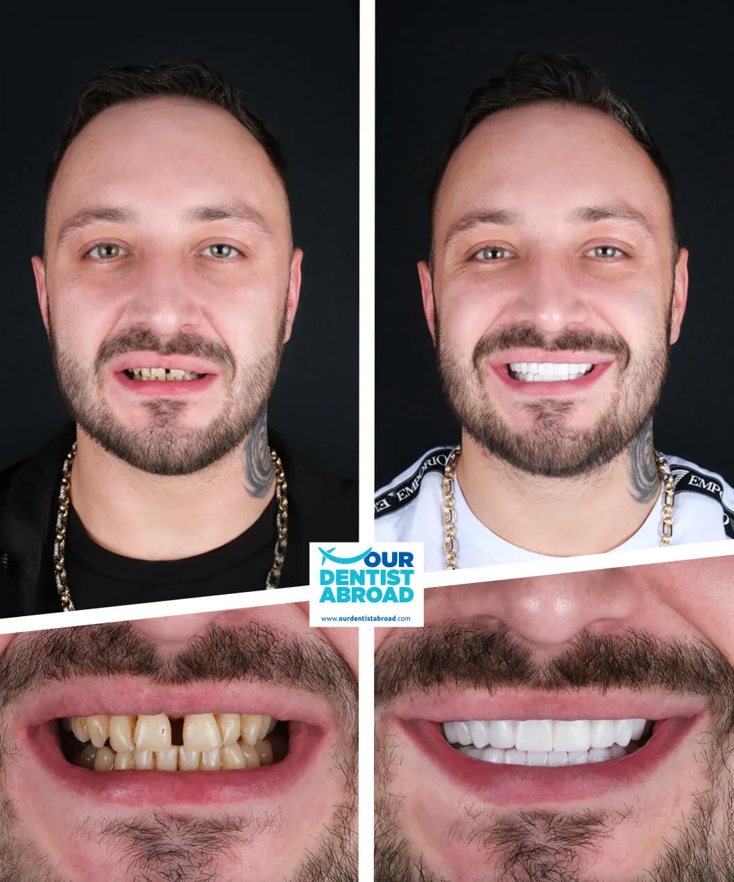 Zirconium crowns before and after
