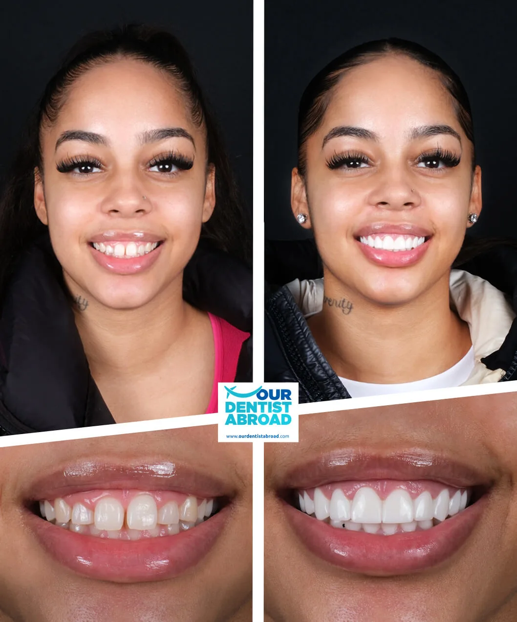 Zirconium crowns before and after