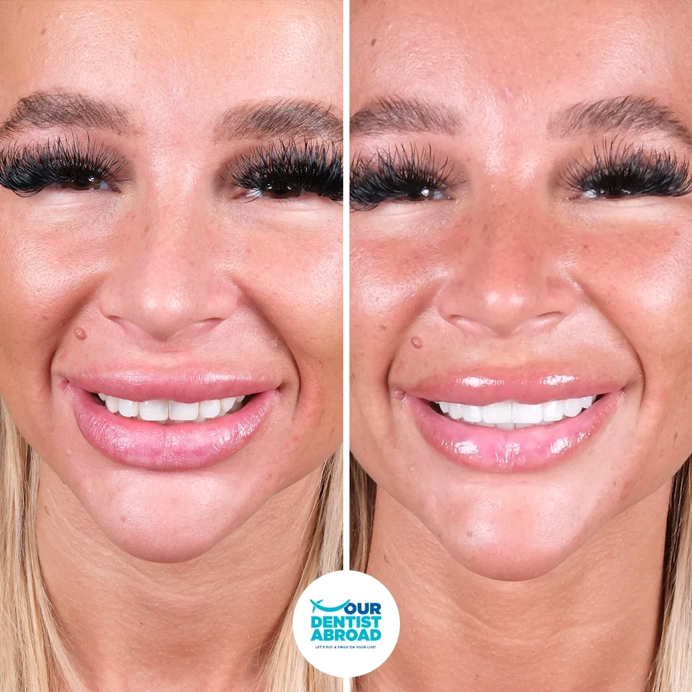 Porcelain veneers before and after