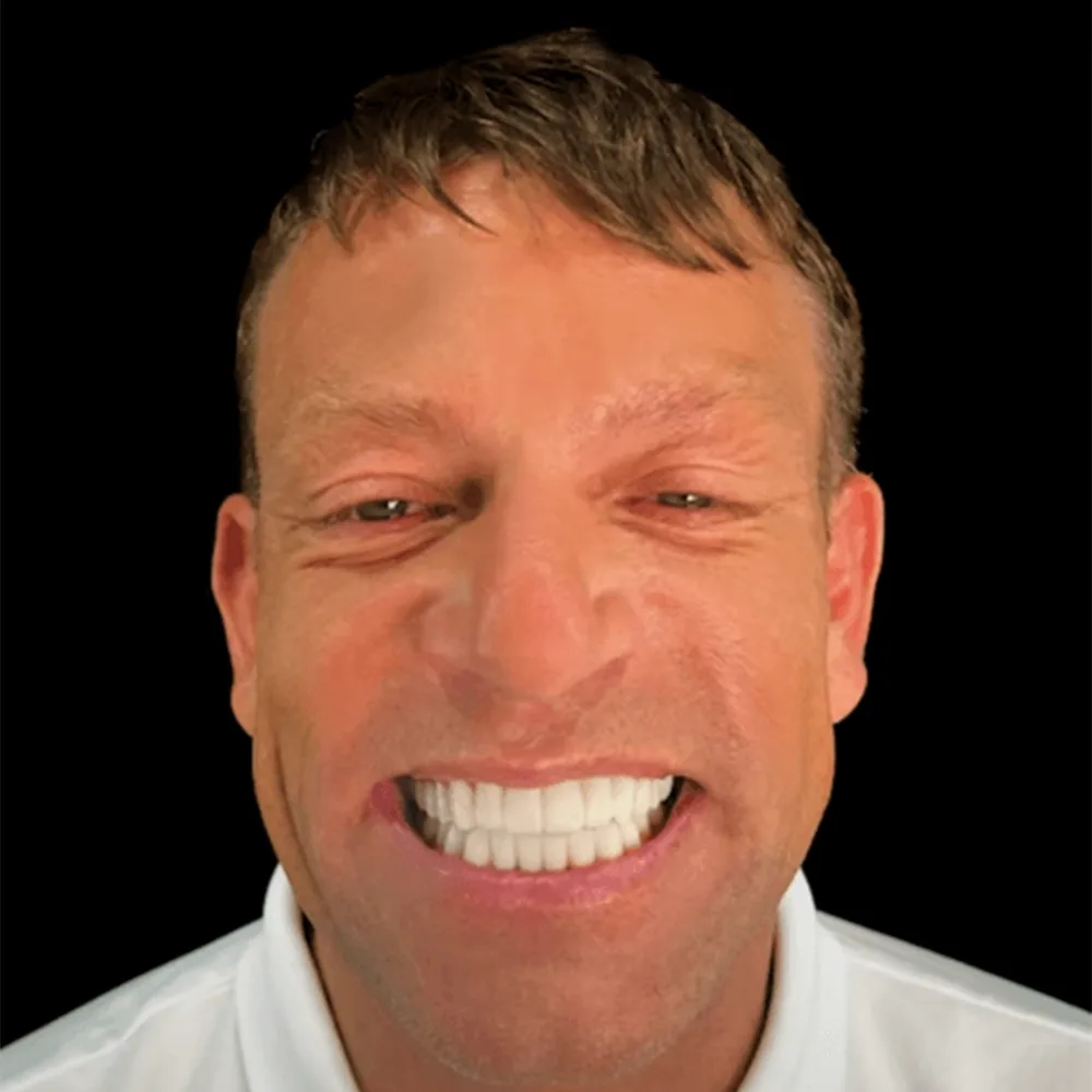 Laminate Veneers result