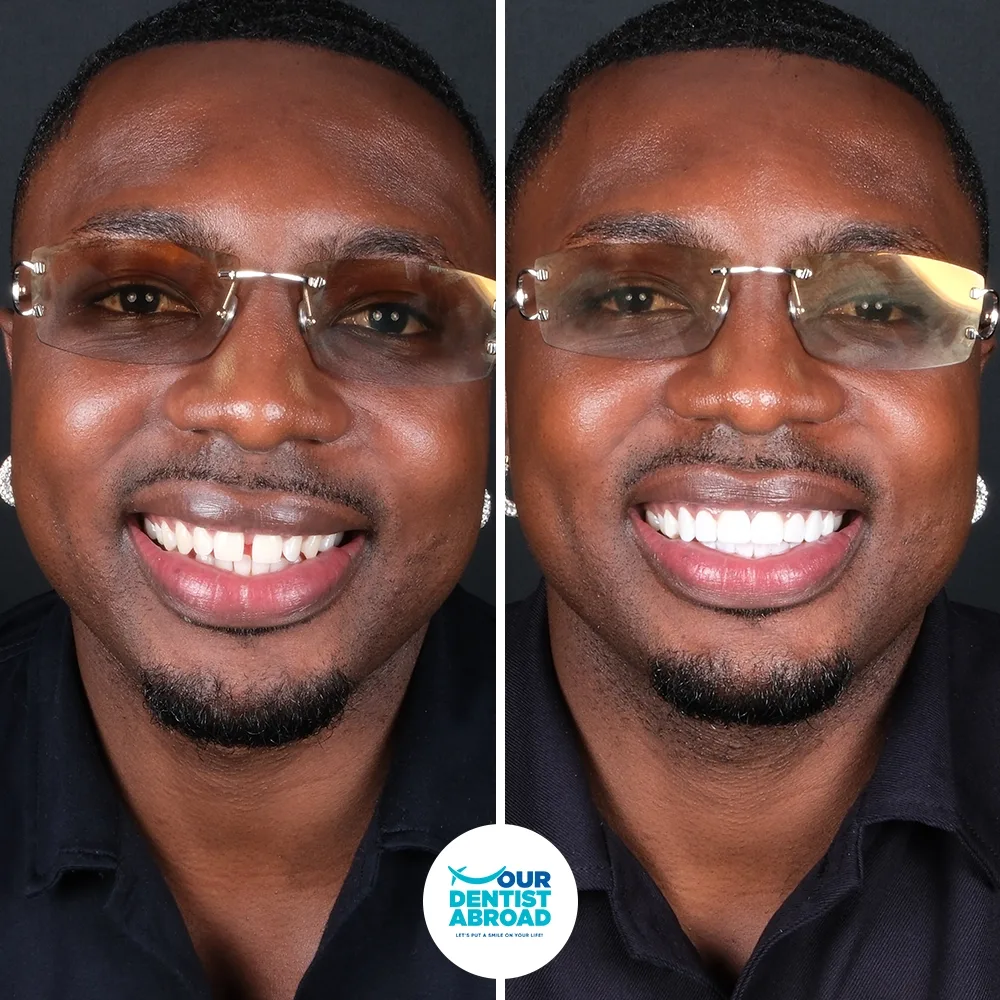 Porcelain veneers before and after