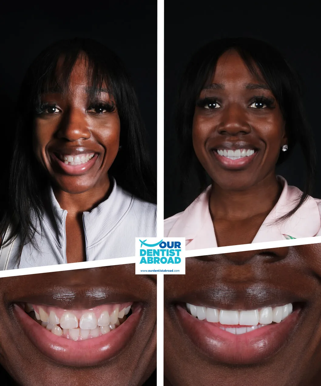 Zirconium crowns before and after