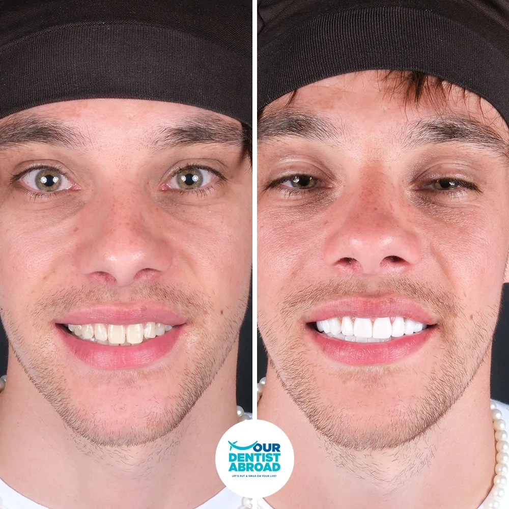 Hollywood Smile before and after