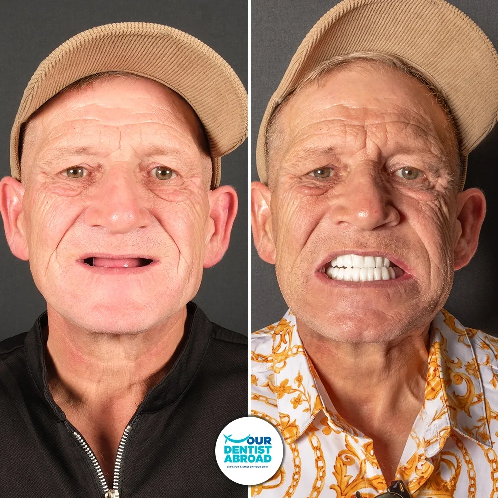 All-on-4 before and after