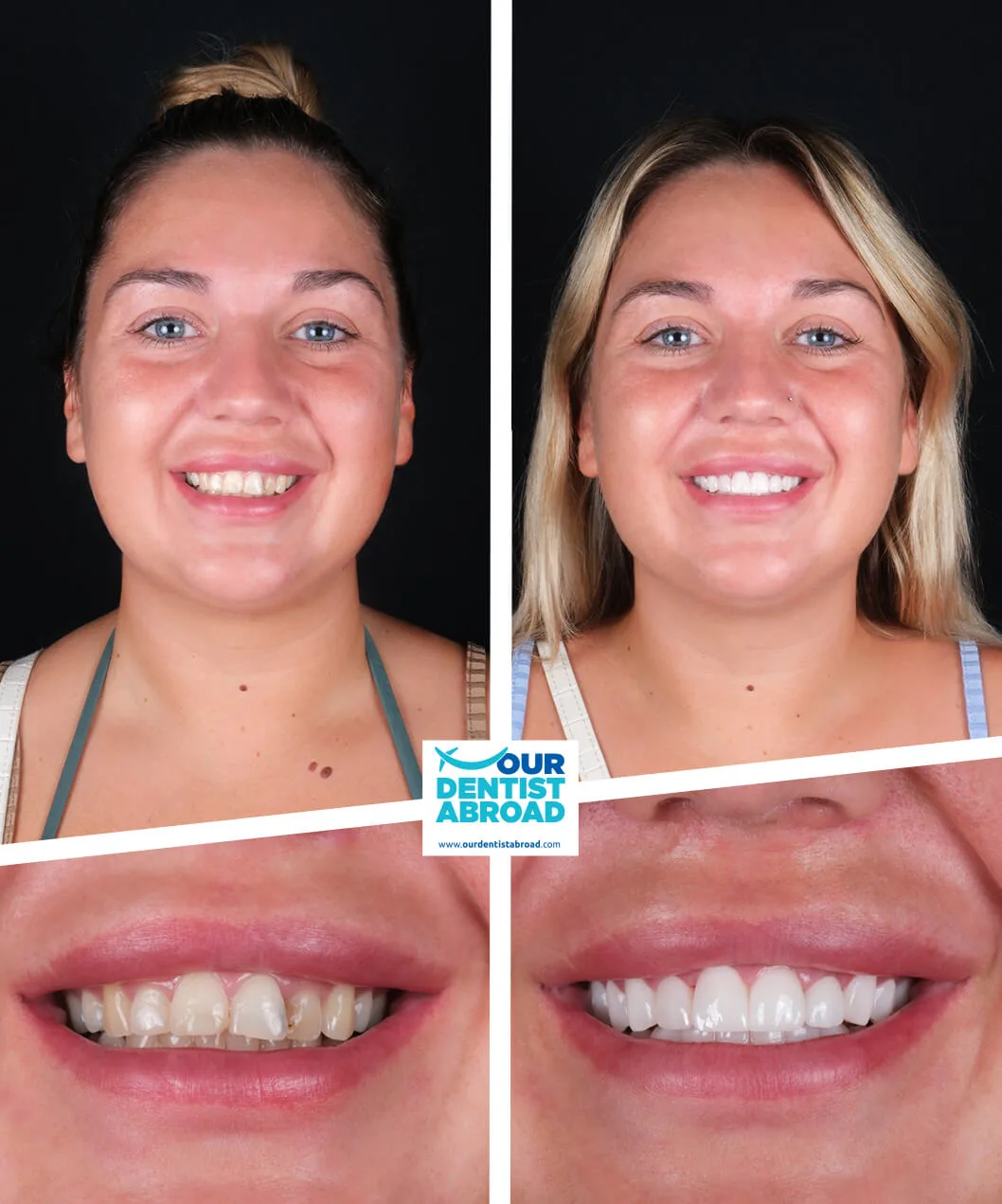 Zirconium crowns before and after