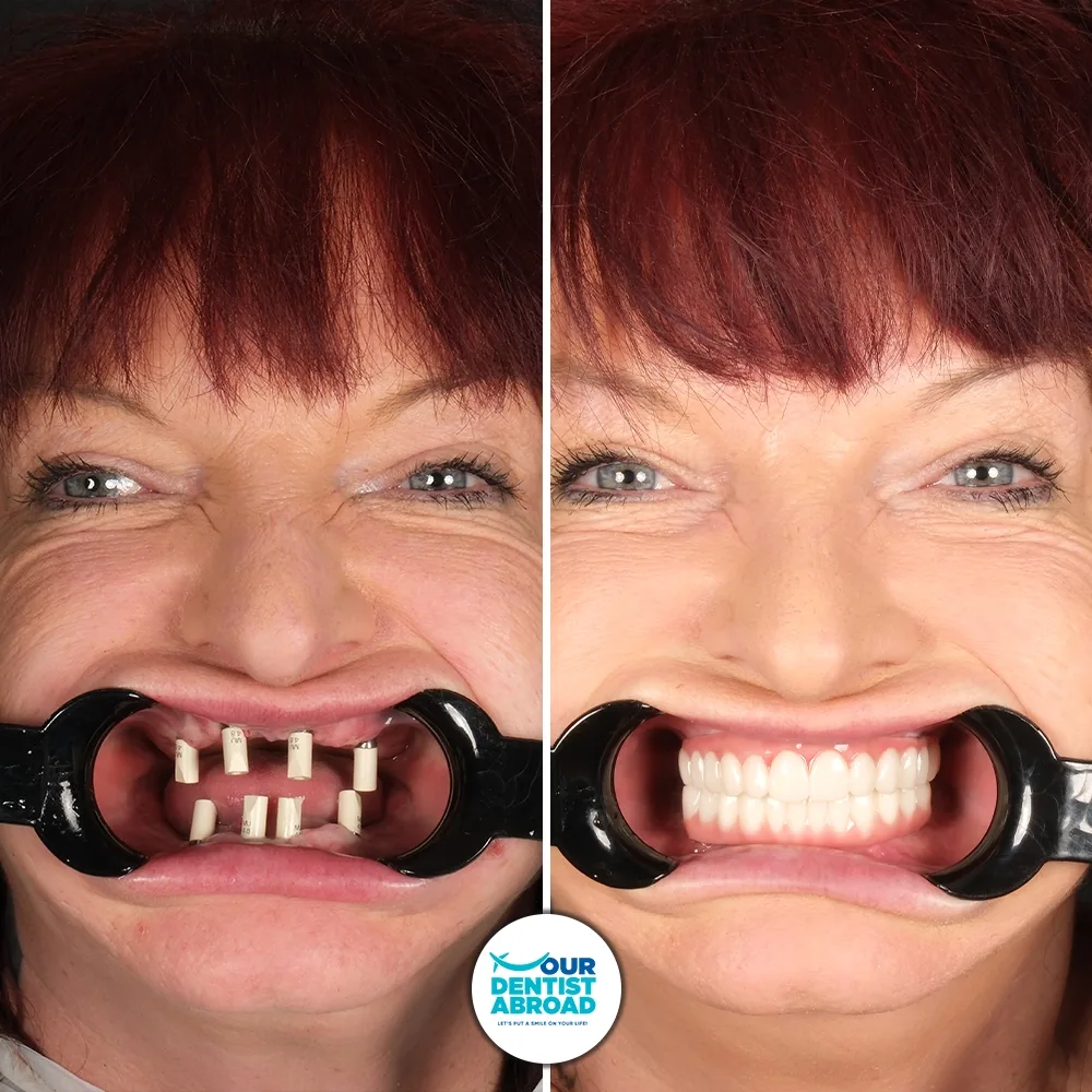 Full mouth implant before and after