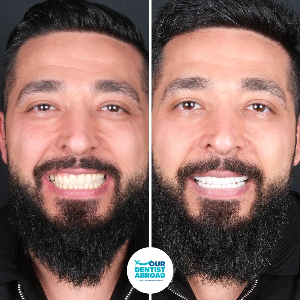 Porcelain veneers before and after