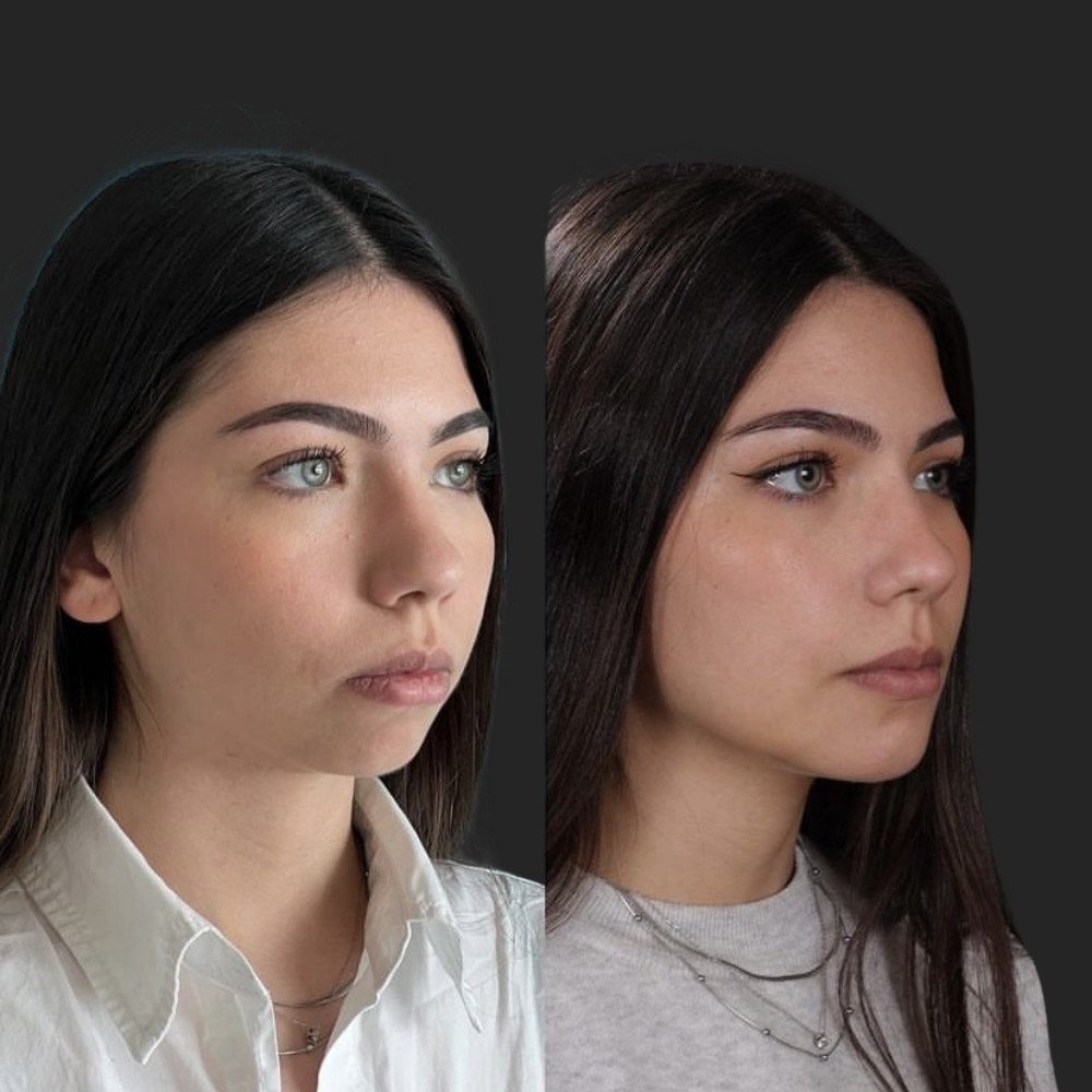 #1 (3) Facial Implants, 22 y.o., 8 days