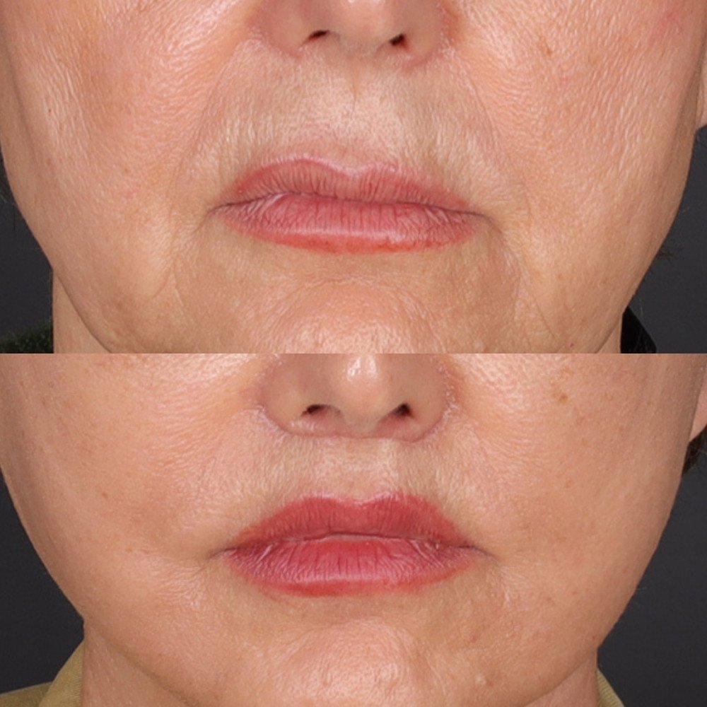 #1 Lip Lift, 67 y.o., 10 days