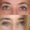 #1 Low. Eyelid, 56 y.o., 18 days