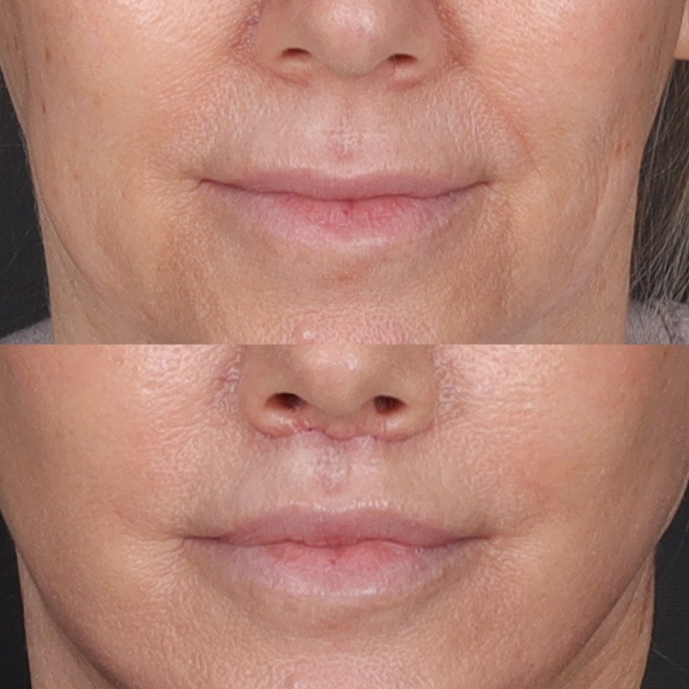#2 Lip Lift, 51 y.o., 15 days