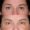 #2 Low. Eyelid, 54 y.o., 10 days
