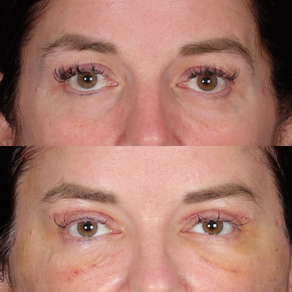 #2 Low. Eyelid, 54 y.o., 10 days