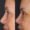 #2 Up. Eyelid, 56 y.o., 9 days