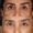 #3 Low. Eyelid, 55 y.o., 17 days