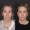 Before and After Facelift Patient 1