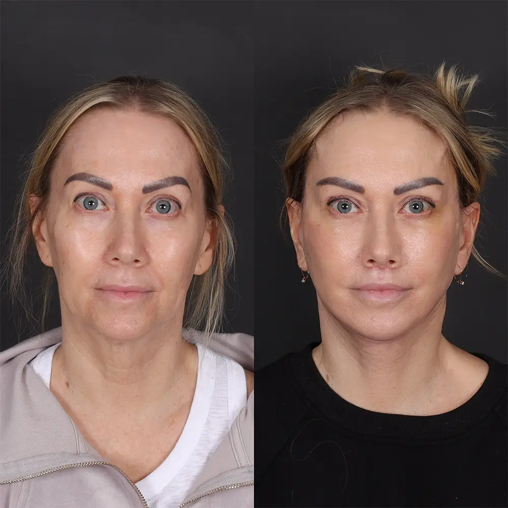 Before and After Facelift Patient 1