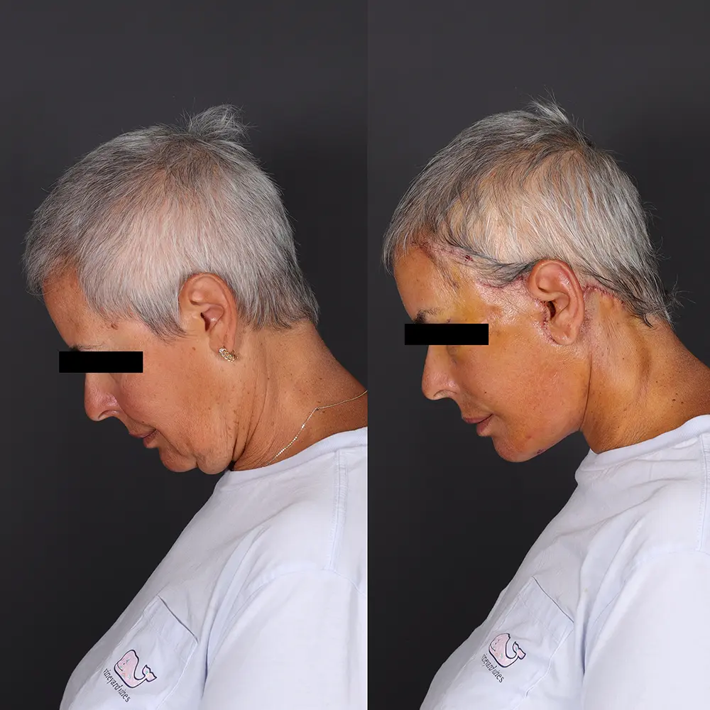 Before and After Facelift Patient 2