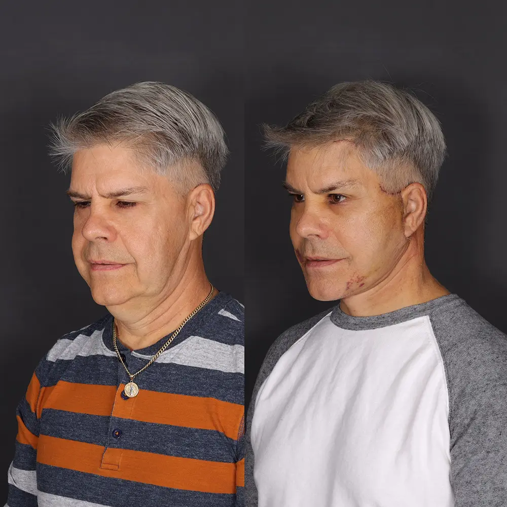 Before and After Facelift Patient 3